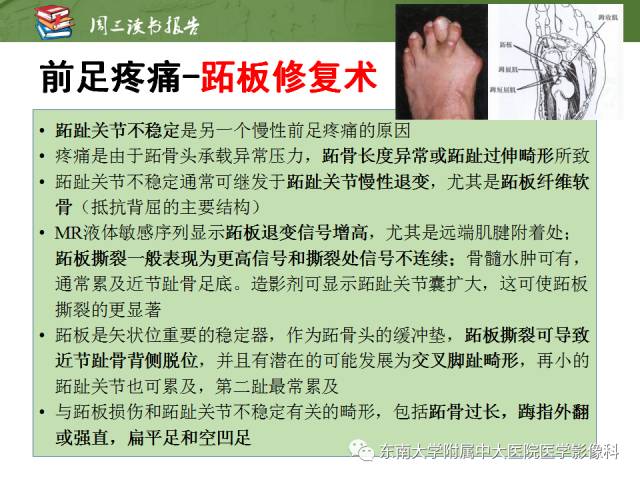 【PPT】踝及足术后CT和MR成像