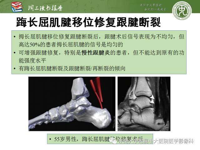 【PPT】踝及足术后CT和MR成像