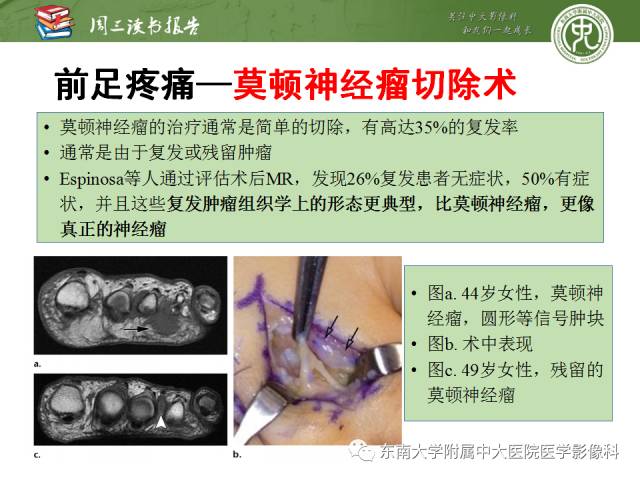 【PPT】踝及足术后CT和MR成像