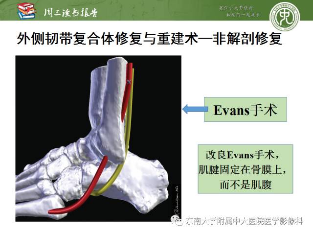 【PPT】踝及足术后CT和MR成像