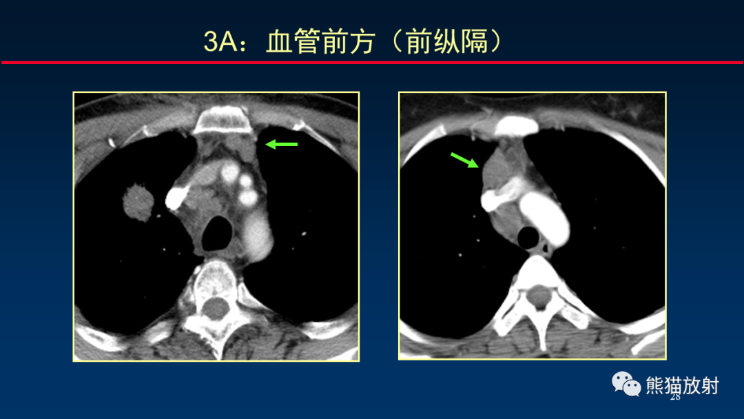 【PPT】纵隔与肺门淋巴结的识别与精准CT分区-28