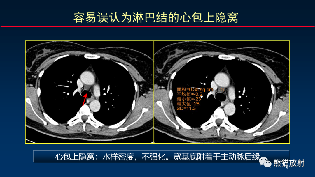 【PPT】纵隔与肺门淋巴结的识别与精准CT分区-9