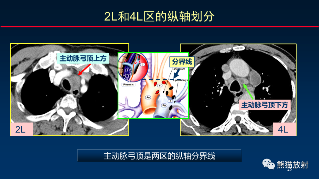 【PPT】纵隔与肺门淋巴结的识别与精准CT分区-25