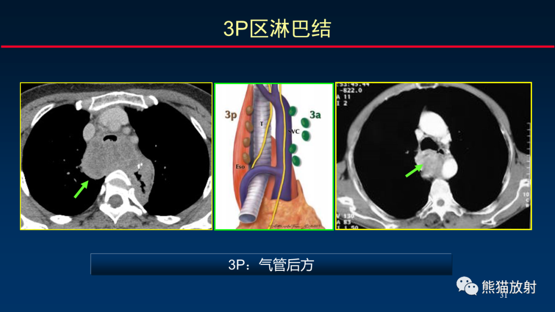 【PPT】纵隔与肺门淋巴结的识别与精准CT分区-31