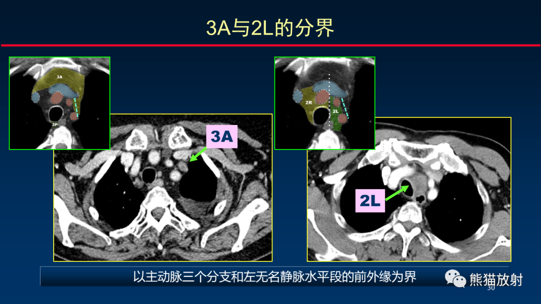 【PPT】纵隔与肺门淋巴结的识别与精准CT分区-30