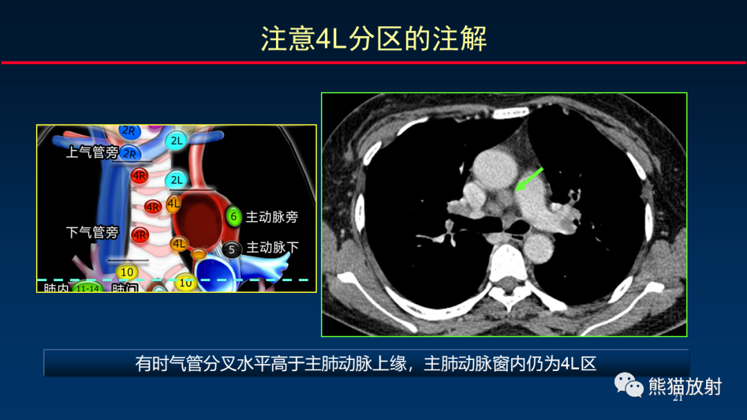 【PPT】纵隔与肺门淋巴结的识别与精准CT分区-21