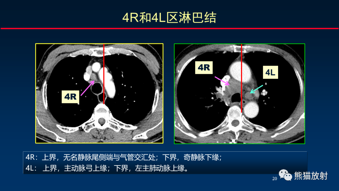 【PPT】纵隔与肺门淋巴结的识别与精准CT分区-20