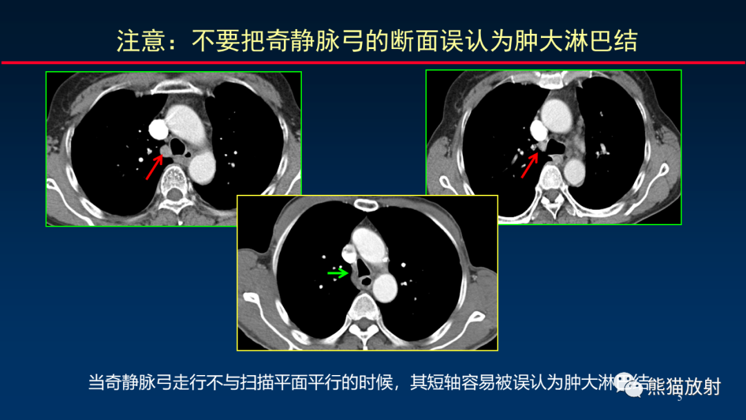 【PPT】纵隔与肺门淋巴结的识别与精准CT分区-5
