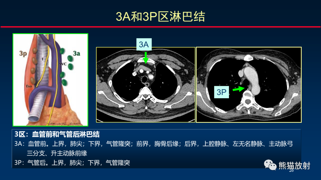 【PPT】纵隔与肺门淋巴结的识别与精准CT分区-26
