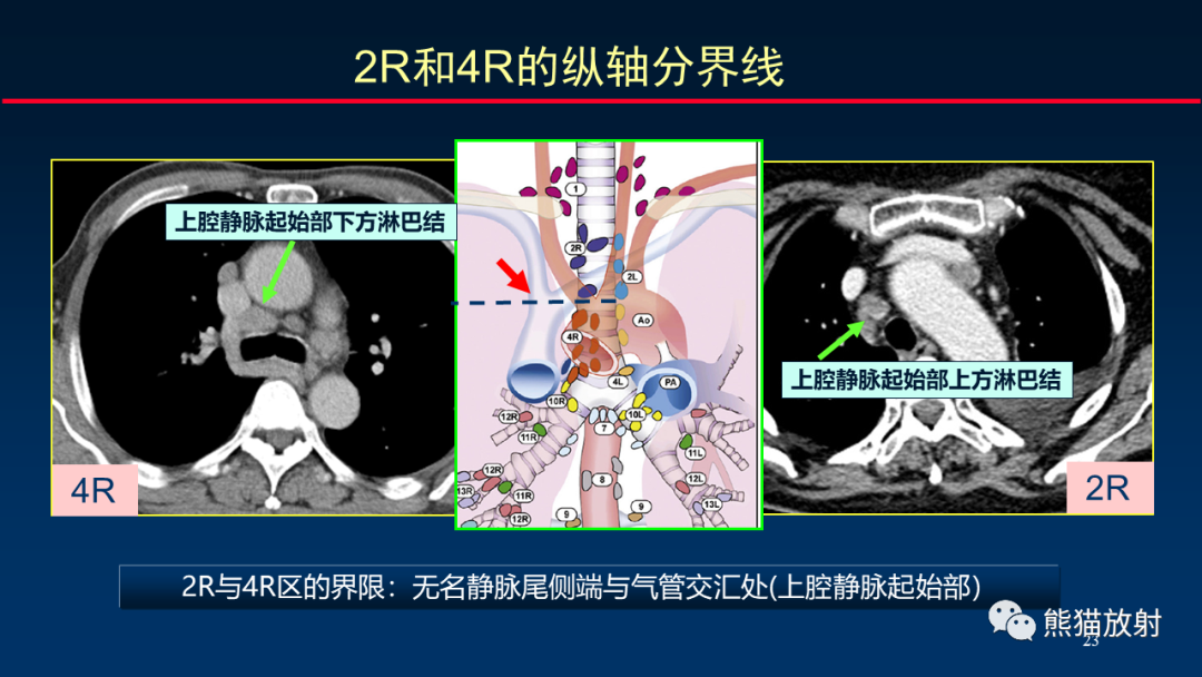 【PPT】纵隔与肺门淋巴结的识别与精准CT分区-23
