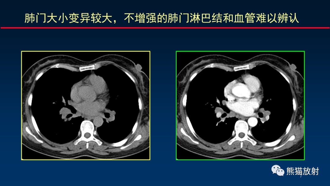 【PPT】纵隔与肺门淋巴结的识别与精准CT分区-7
