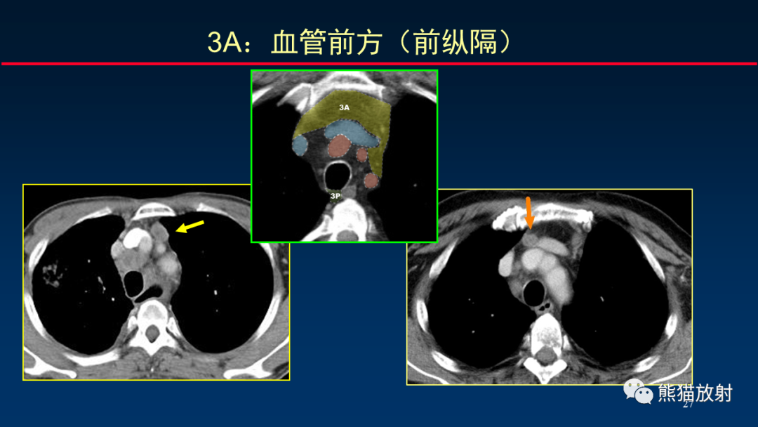 【PPT】纵隔与肺门淋巴结的识别与精准CT分区-27