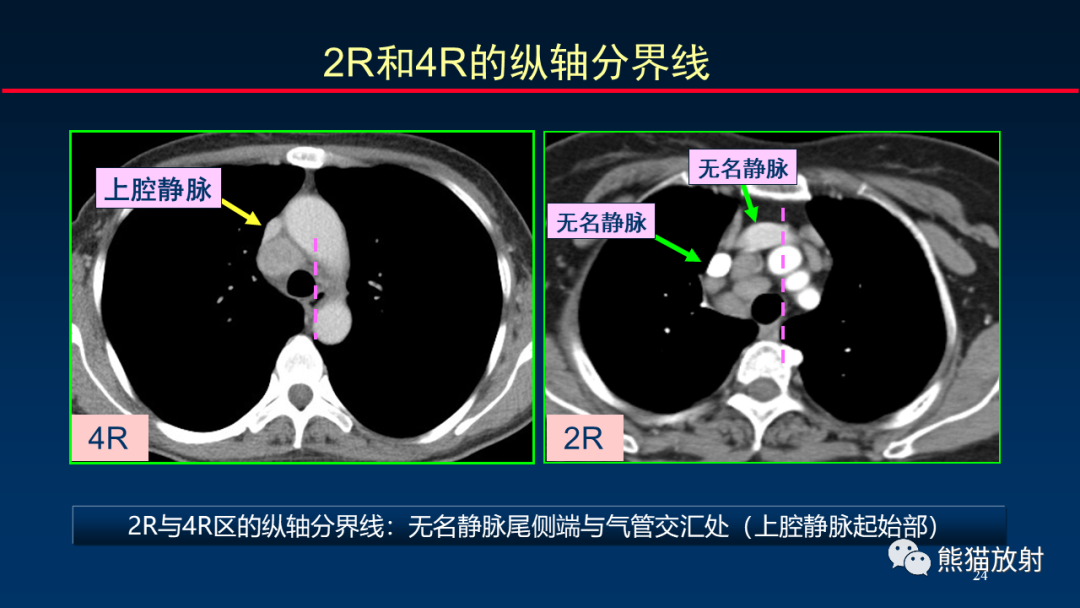 【PPT】纵隔与肺门淋巴结的识别与精准CT分区-24
