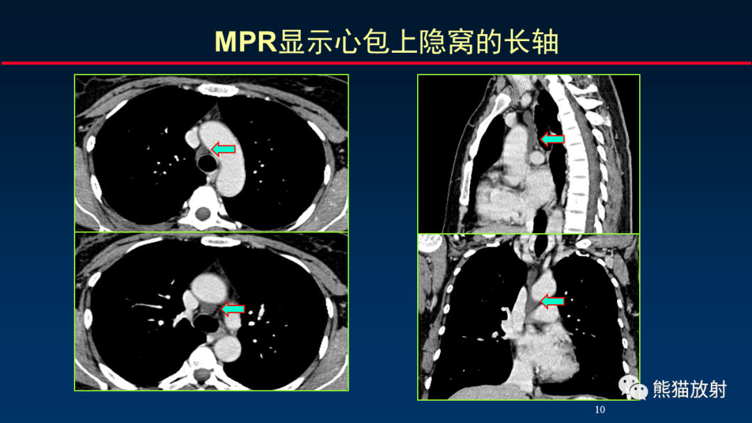 【PPT】纵隔与肺门淋巴结的识别与精准CT分区-10