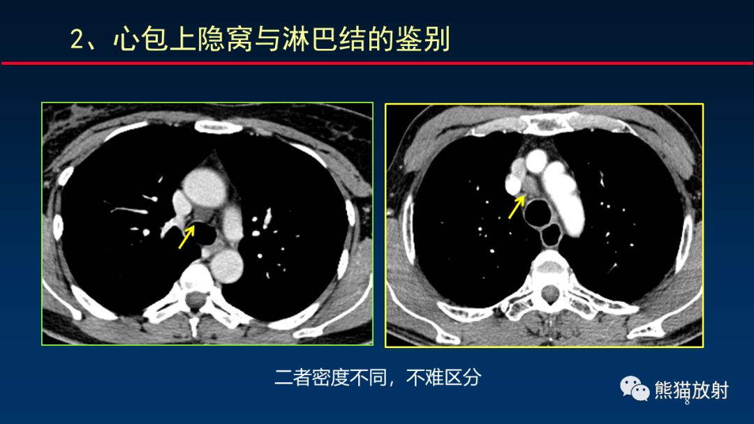 【PPT】纵隔与肺门淋巴结的识别与精准CT分区-8