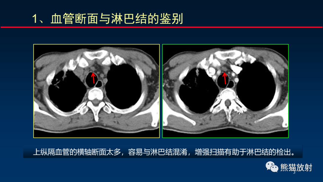 【PPT】纵隔与肺门淋巴结的识别与精准CT分区-3