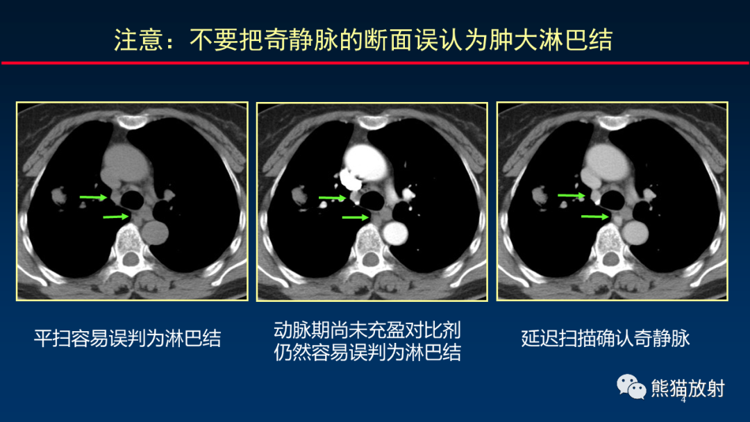 【PPT】纵隔与肺门淋巴结的识别与精准CT分区-4