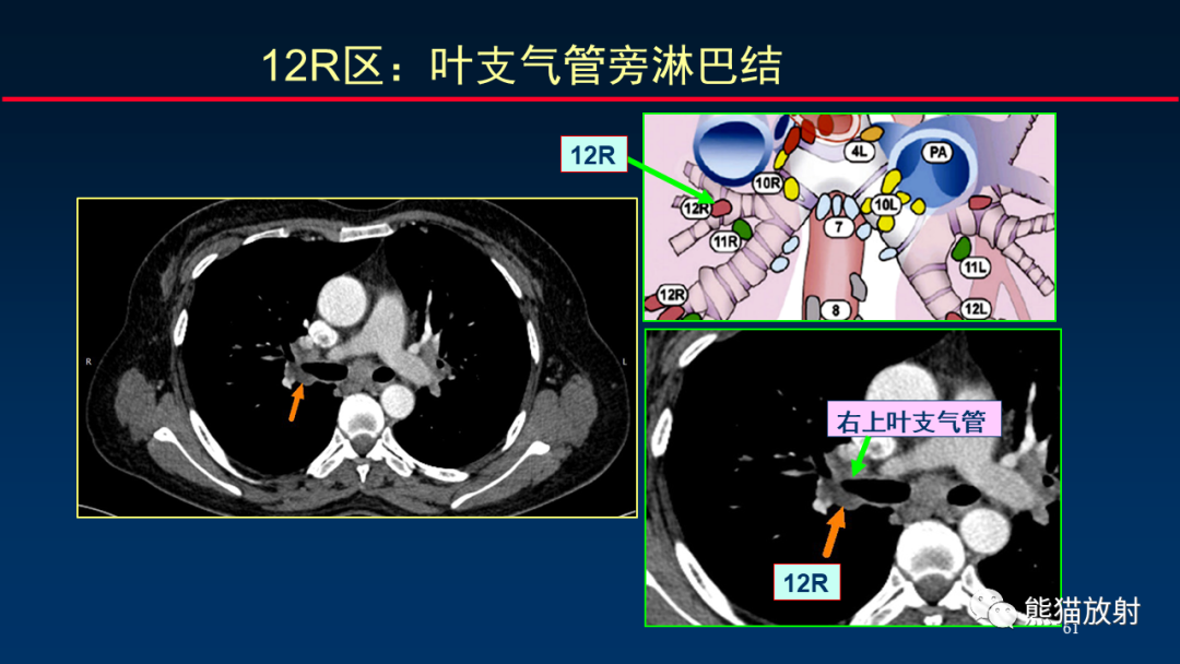 【PPT】纵隔与肺门淋巴结的识别与精准CT分区-61