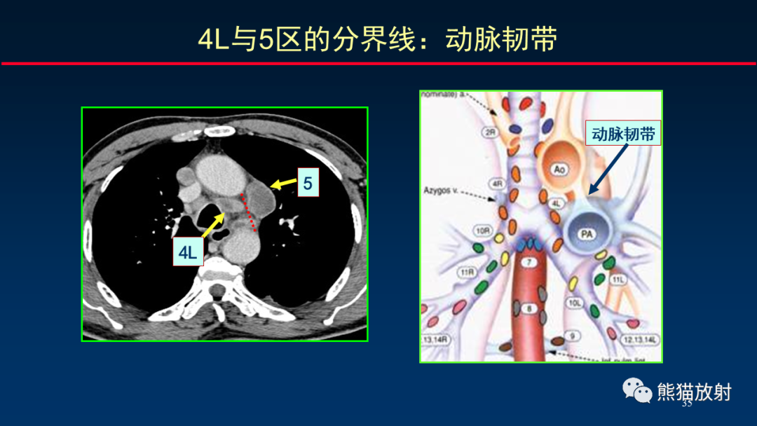【PPT】纵隔与肺门淋巴结的识别与精准CT分区-35