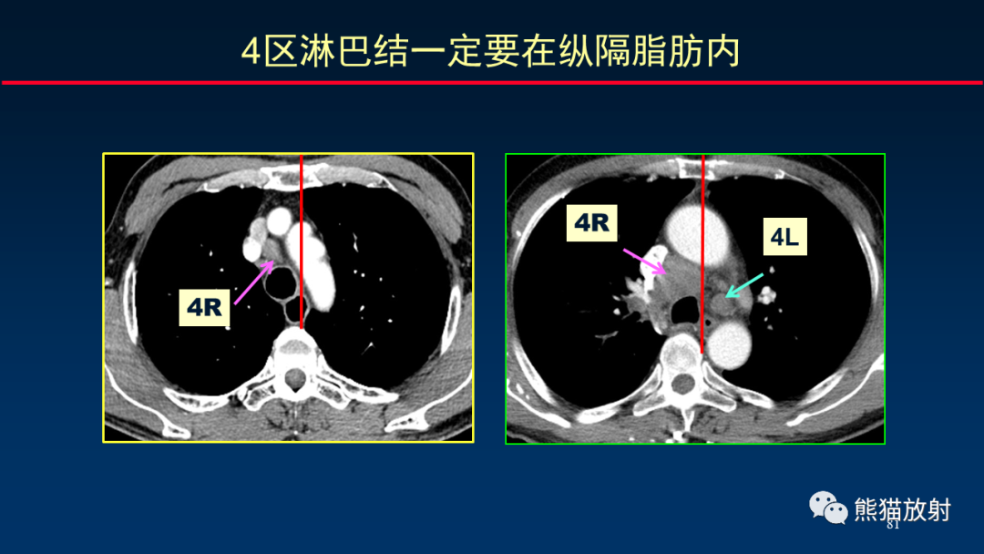 【PPT】纵隔与肺门淋巴结的识别与精准CT分区-81