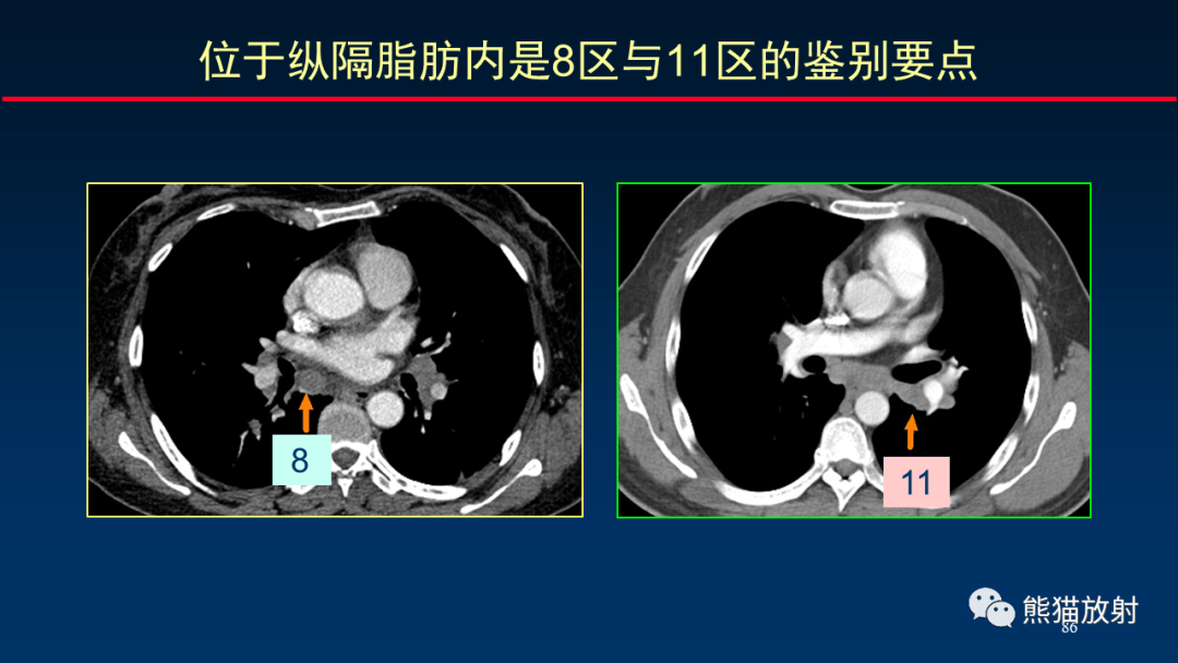 【PPT】纵隔与肺门淋巴结的识别与精准CT分区-86