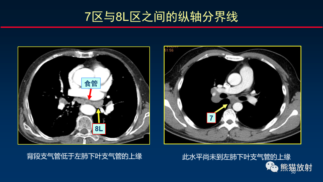 【PPT】纵隔与肺门淋巴结的识别与精准CT分区-50