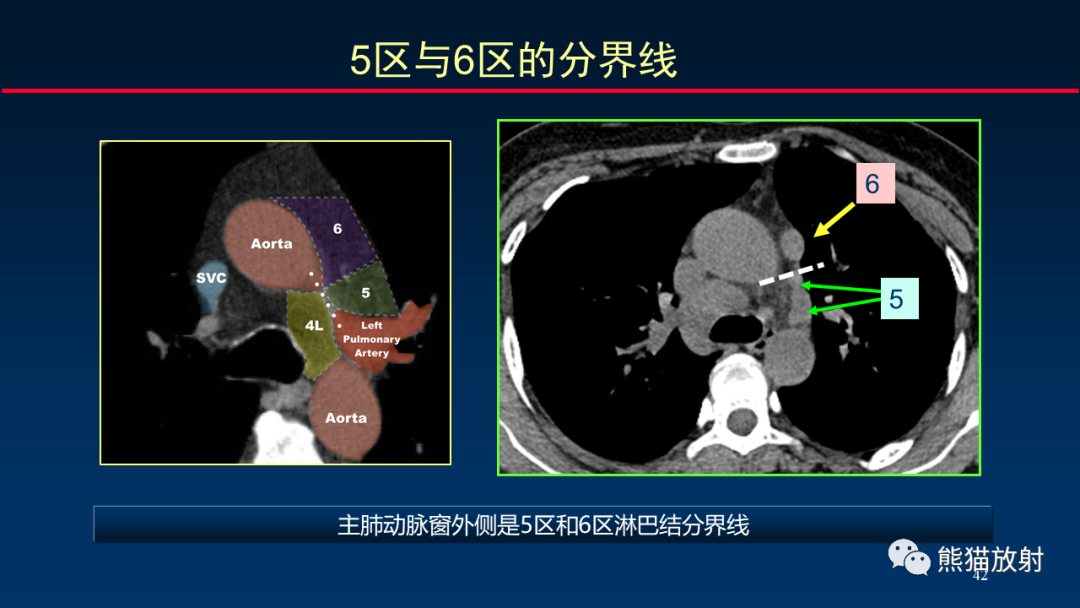 【PPT】纵隔与肺门淋巴结的识别与精准CT分区-42