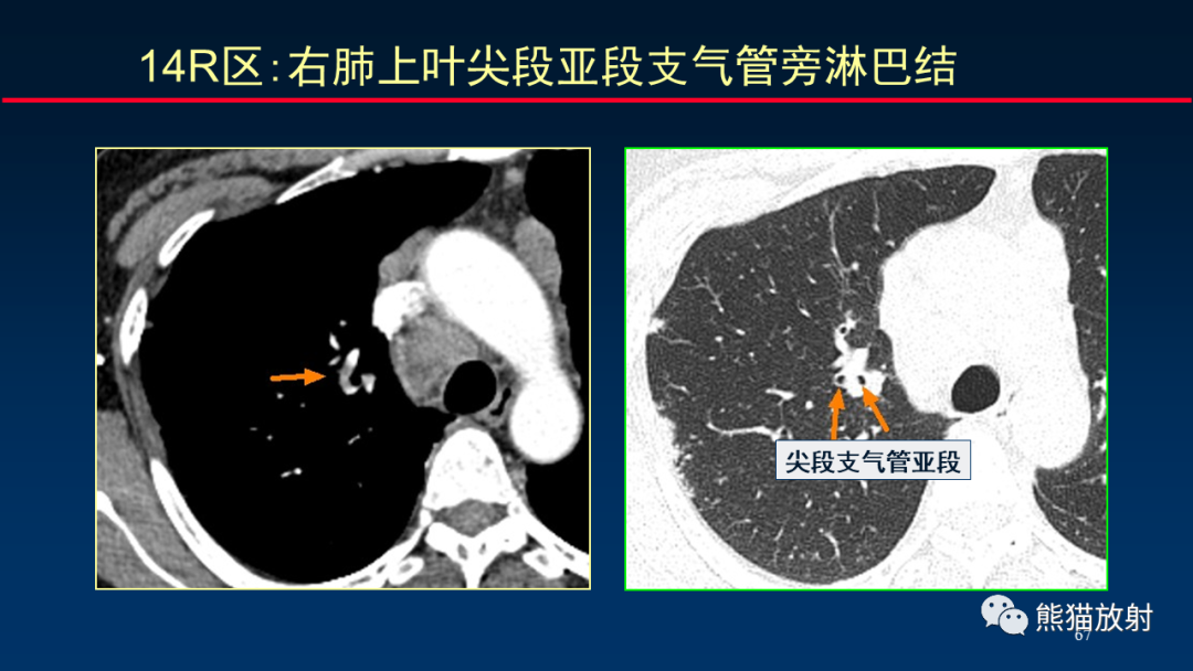 【PPT】纵隔与肺门淋巴结的识别与精准CT分区-67