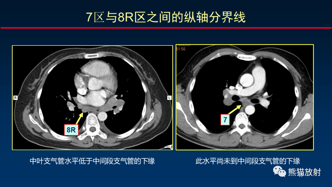 【PPT】纵隔与肺门淋巴结的识别与精准CT分区-49