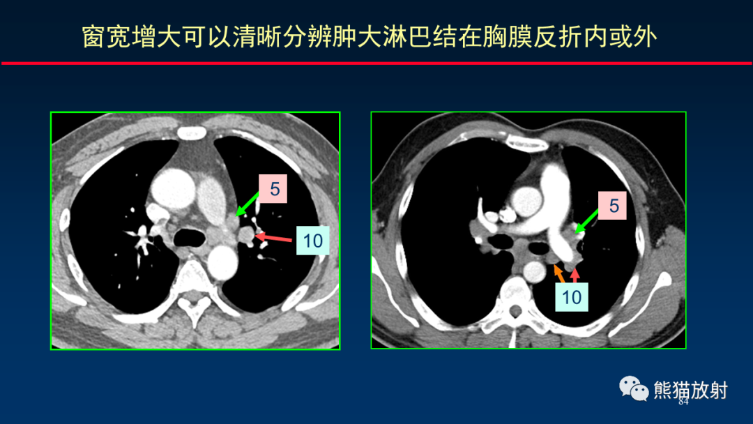 【PPT】纵隔与肺门淋巴结的识别与精准CT分区-84