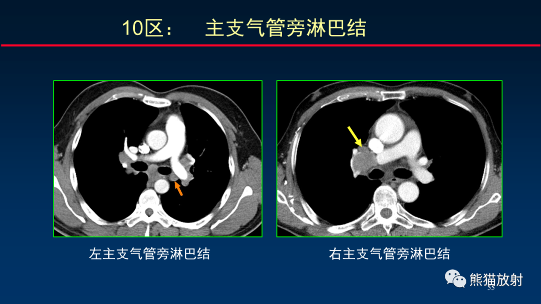 【PPT】纵隔与肺门淋巴结的识别与精准CT分区-55