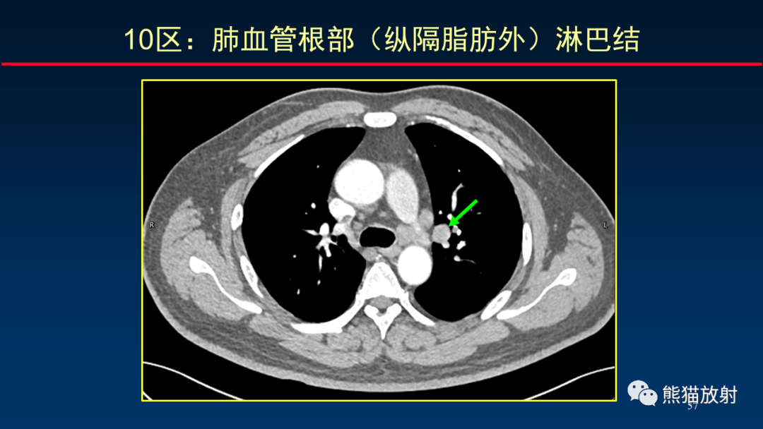 【PPT】纵隔与肺门淋巴结的识别与精准CT分区-57