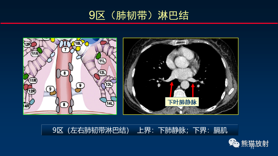 【PPT】纵隔与肺门淋巴结的识别与精准CT分区-51