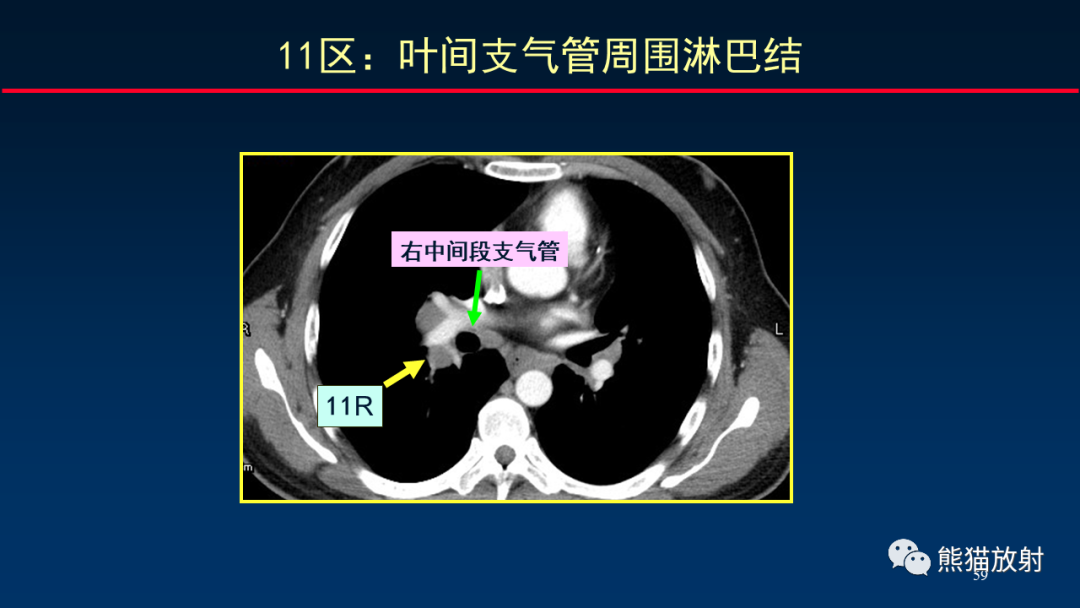 【PPT】纵隔与肺门淋巴结的识别与精准CT分区-59