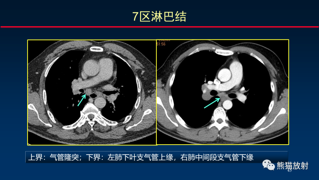 【PPT】纵隔与肺门淋巴结的识别与精准CT分区-45