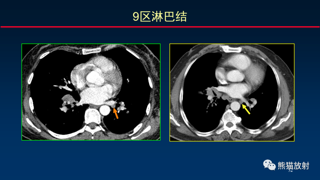 【PPT】纵隔与肺门淋巴结的识别与精准CT分区-52