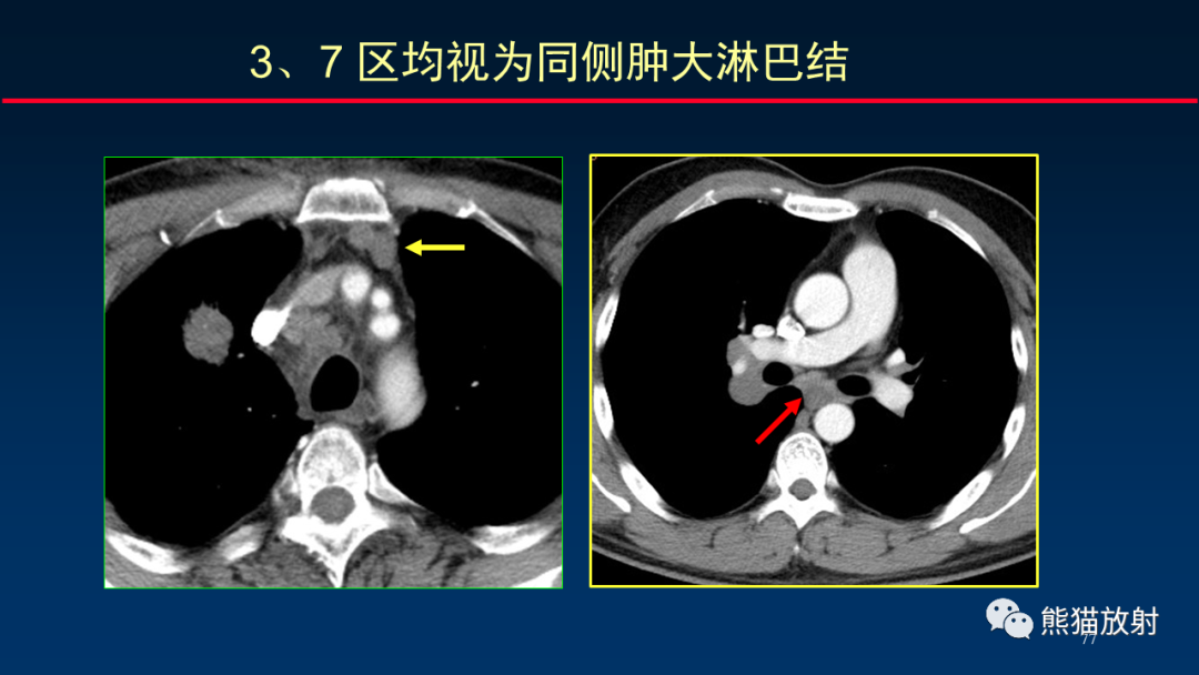 【PPT】纵隔与肺门淋巴结的识别与精准CT分区-77