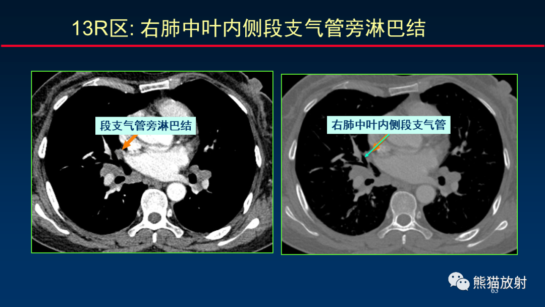 【PPT】纵隔与肺门淋巴结的识别与精准CT分区-63