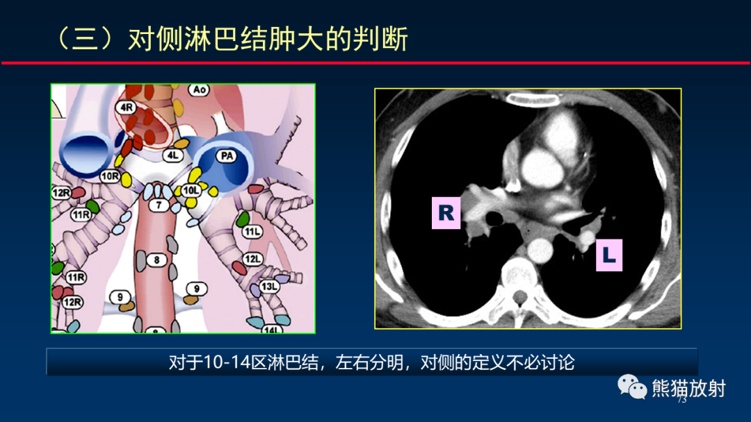 【PPT】纵隔与肺门淋巴结的识别与精准CT分区-73