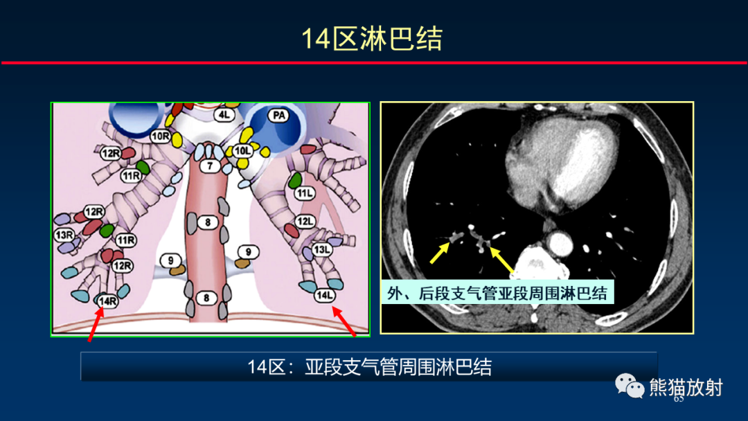 【PPT】纵隔与肺门淋巴结的识别与精准CT分区-65