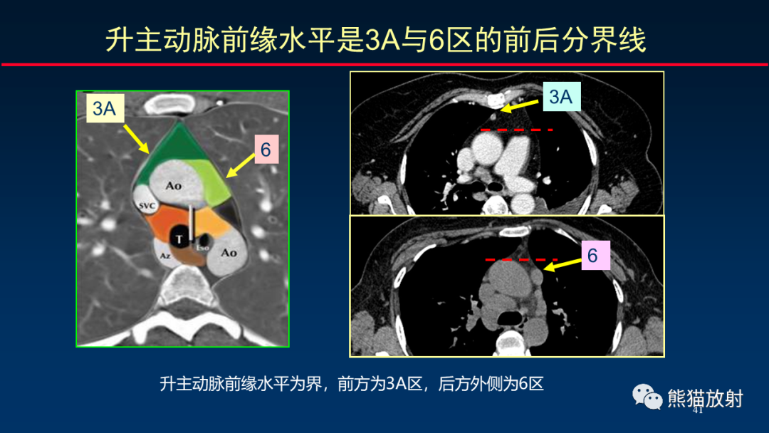 【PPT】纵隔与肺门淋巴结的识别与精准CT分区-41