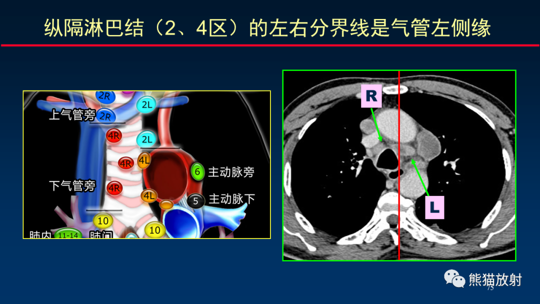 【PPT】纵隔与肺门淋巴结的识别与精准CT分区-75