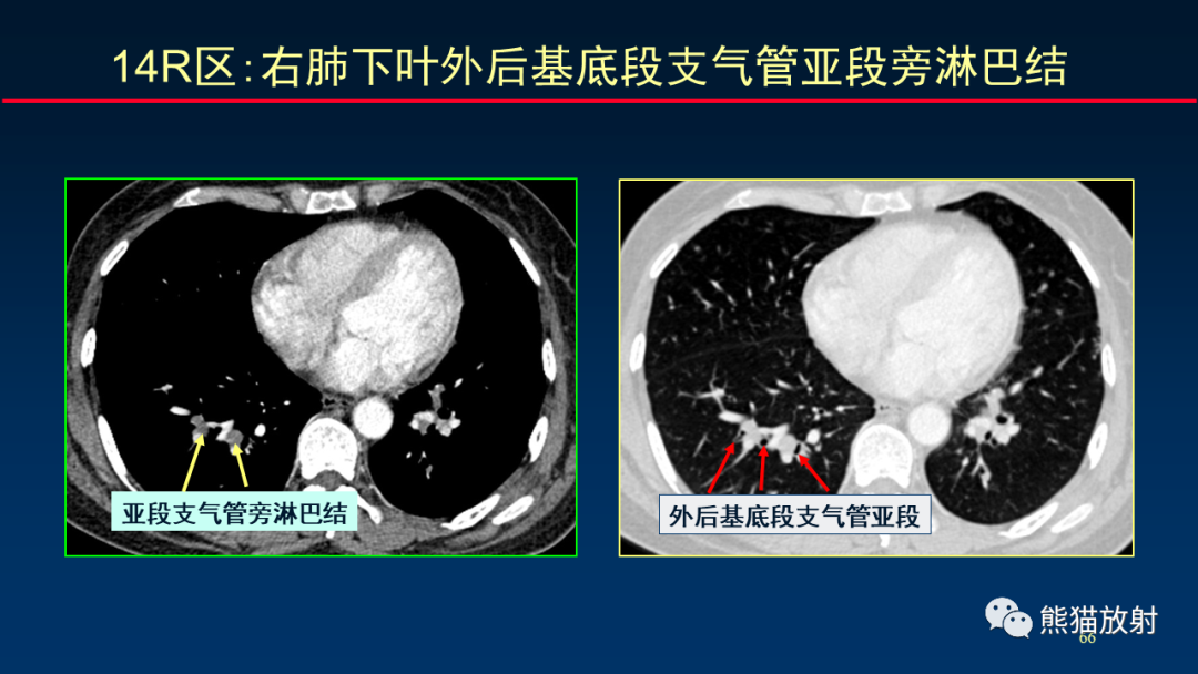 【PPT】纵隔与肺门淋巴结的识别与精准CT分区-66