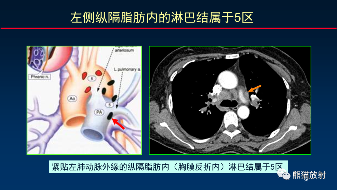 【PPT】纵隔与肺门淋巴结的识别与精准CT分区-36