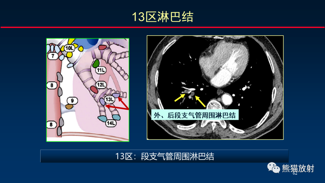 【PPT】纵隔与肺门淋巴结的识别与精准CT分区-62