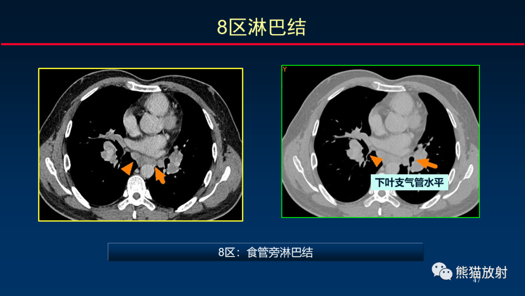 【PPT】纵隔与肺门淋巴结的识别与精准CT分区-47