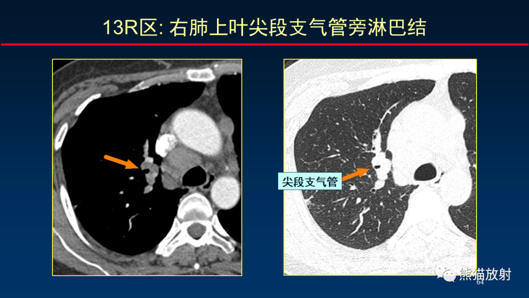 【PPT】纵隔与肺门淋巴结的识别与精准CT分区-64