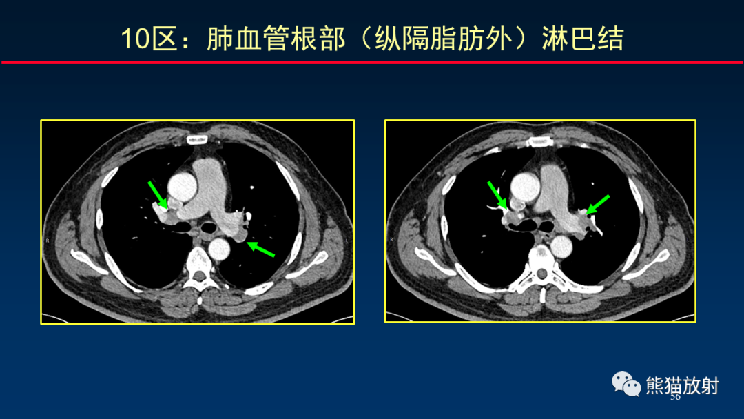 【PPT】纵隔与肺门淋巴结的识别与精准CT分区-56