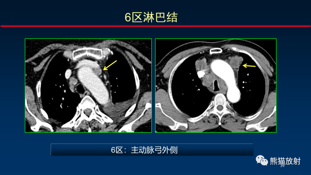 【PPT】纵隔与肺门淋巴结的识别与精准CT分区-39
