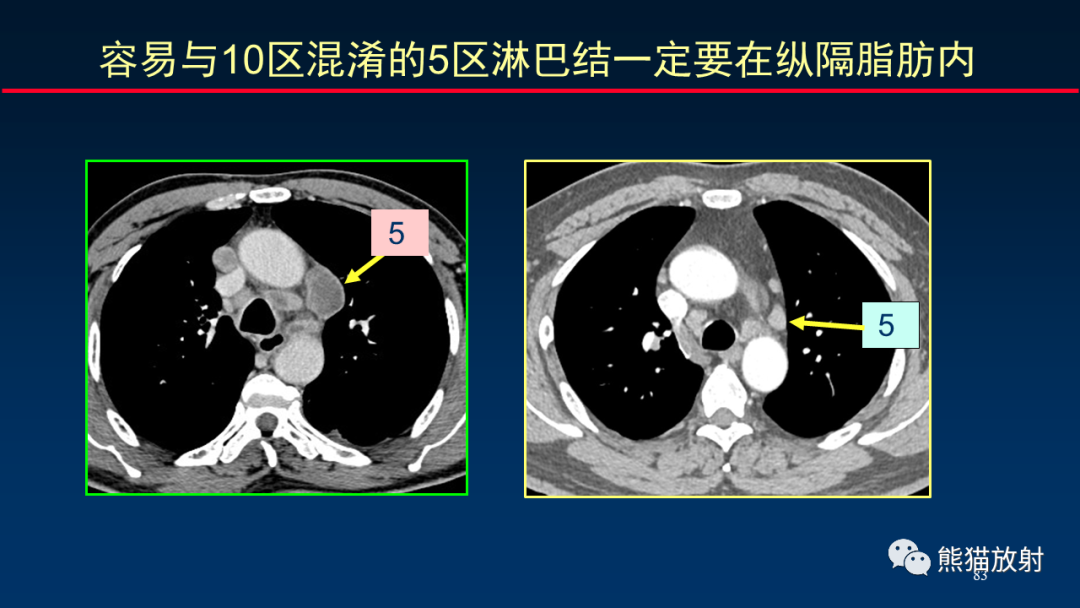 【PPT】纵隔与肺门淋巴结的识别与精准CT分区-83